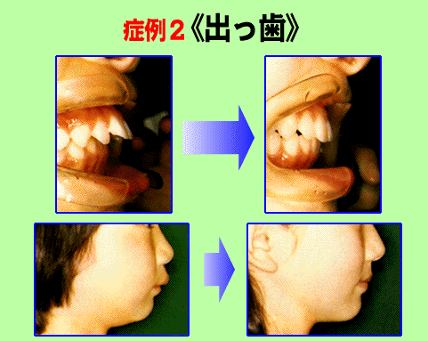 綺麗な歯へのABC