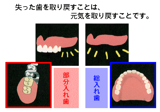 入れ歯について