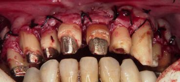 歯槽膿漏を手術によって審美的にした症例
