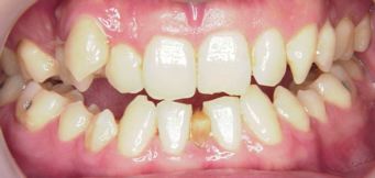 過剰な歯による審美障害