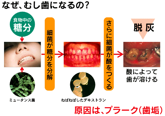 なぜ虫歯になるの？？