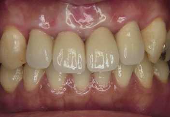歯ぐきの手術について