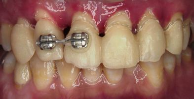 先天的に着色した歯の色と形の回復