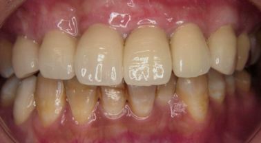 先天的に着色した歯の色と形の回復