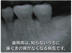 歯槽膿漏
