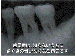 歯槽膿漏