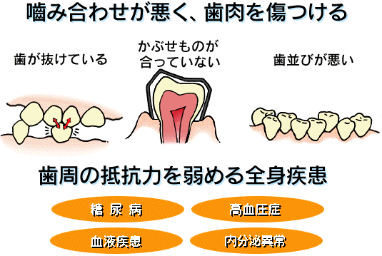 歯槽膿漏