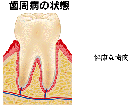 歯槽膿漏