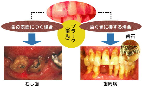 プラークコントロール