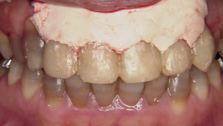 矯正と歯ぐきの手術を併用した症例