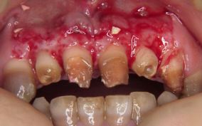 矯正と歯ぐきの手術を併用した症例