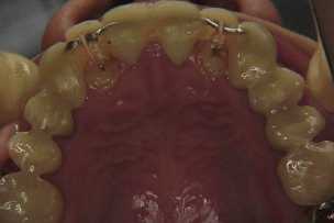 矯正と歯ぐきの手術を併用した症例