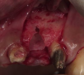 抜歯と同時にインプラント埋入