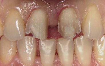 前歯が離れている症例
